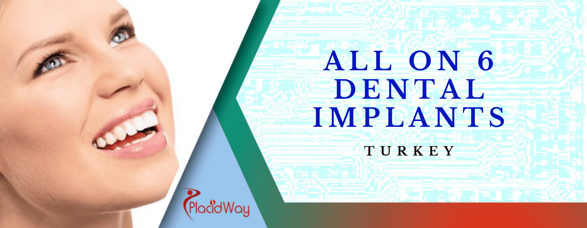 All on 6 Dental Implants in Turkey